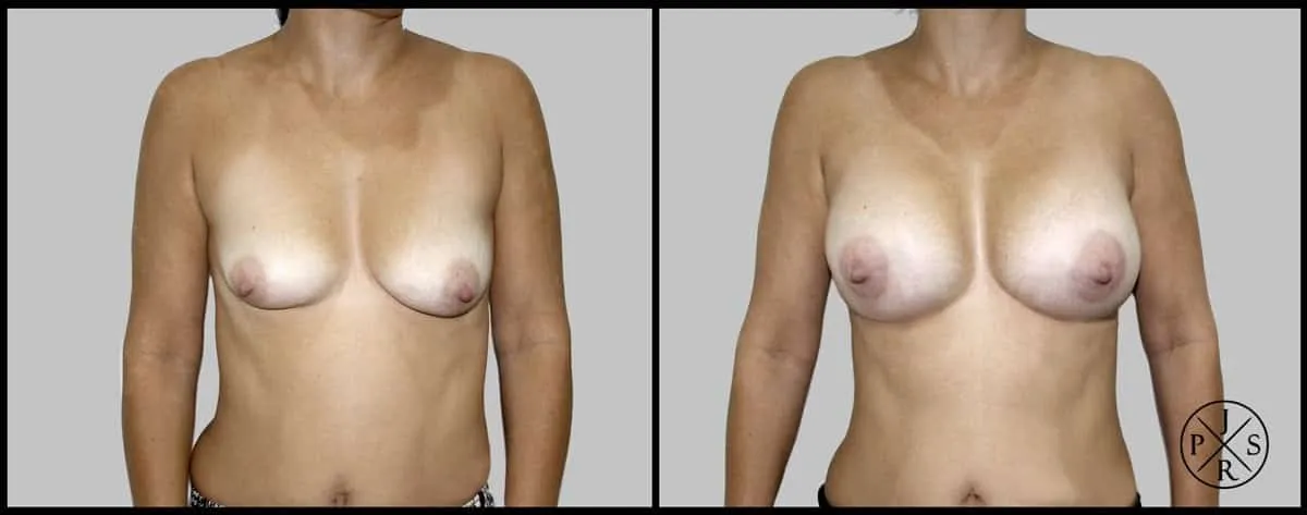 Breast Reconstruction Before & After - Before