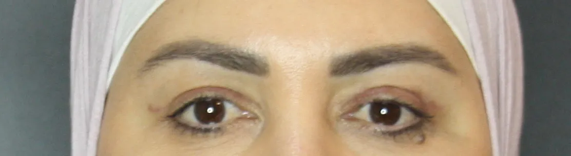 Front View - After