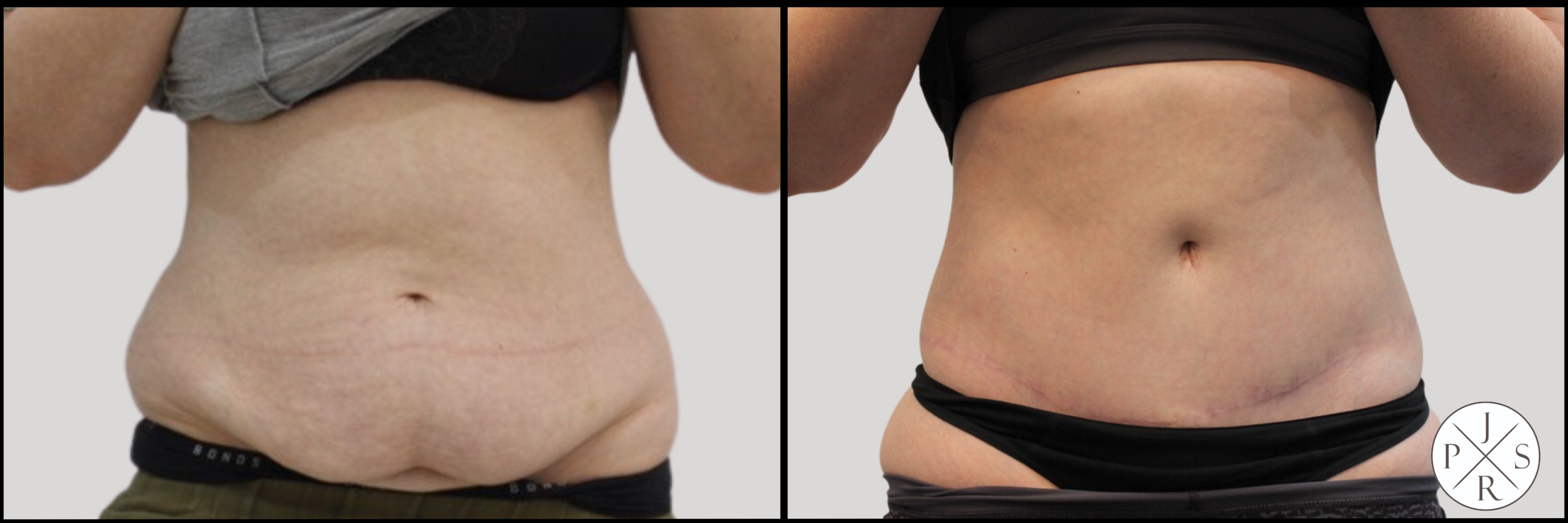 Skin defect closure with reverse abdominoplasty flap.