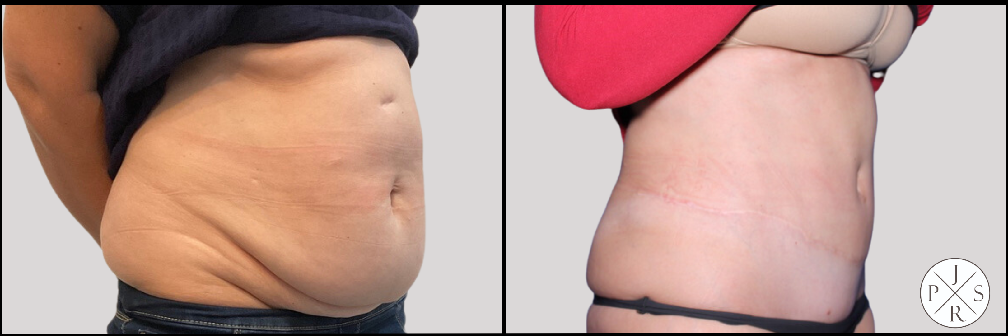 Lipoabdominoplasty – Before & After – Case 70250 - Dr. Marco Romeo
