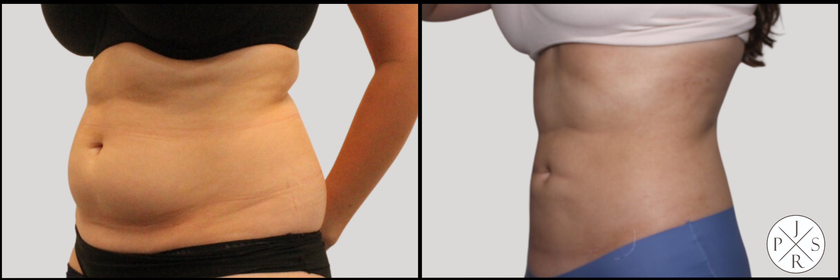 Reshaping Your Body with Liposuction Combined with Abdominoplasty - Dr.  Mohaghegh Plastic Surgeon, Sydney