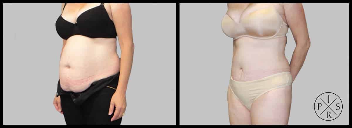 Abdominoplasty Before & After Image